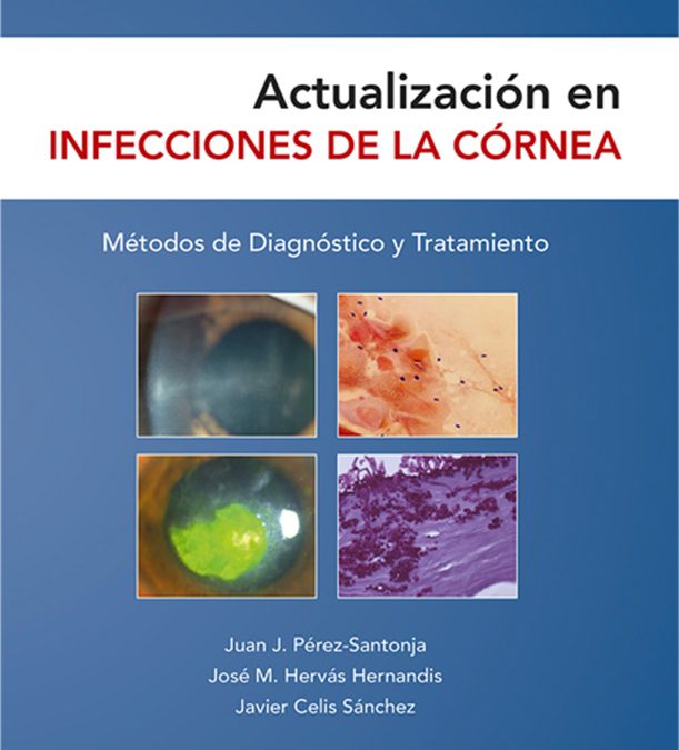 Actualización en infecciones de  la córnea. Métodos de Diagnóstico  y Tratamiento
