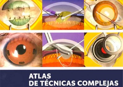 Atlas de Técnicas Complejas en la Cirugía del Segmento Anterior