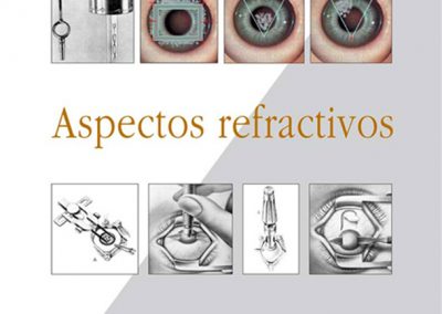 Queratoplastia: aspectos refractivos