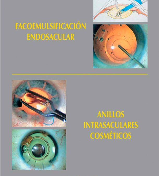 Facoemulsificación endosacular / Anillos intrasaculares cosméticos